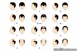 鋸棕櫚可以減少男性脱髮