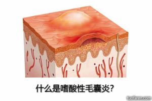 什麼是嗜酸性毛囊炎？