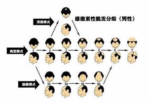 雄激素性脱髮怎麼治療