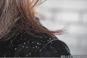 頭皮屑和脱髮