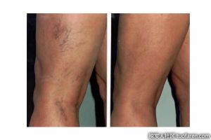 什麼導致腿毛脱落？