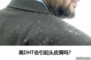 高DHT會引起頭皮屑嗎？