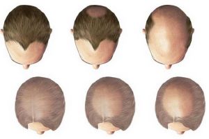 雄激素性脱髮的病因及治療
