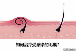 如何治療受感染的毛囊？