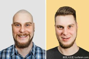 頭髮移植和藥物治療哪個對我更好？