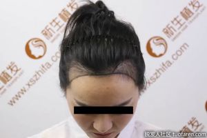 新生植髮效果：女神植髮真實恢復過程!