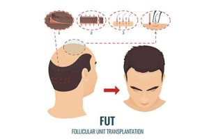 FUT植髮技術治療脱髮