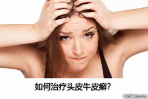 如何治療頭皮牛皮癬？