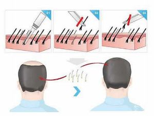 頭髮移植的5點術後注意事項
