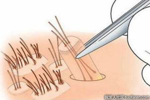 頭髮移植到底有沒有副作用？