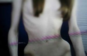 厭食症對頭髮不好的影響