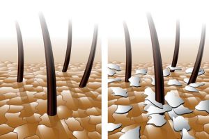 天然療法可快速有效地防止脱髮，頭皮屑