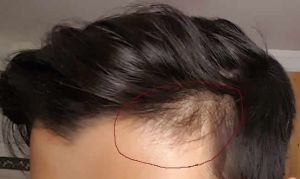 如何再生太陽穴毛髮