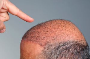 頭髮移植的風險