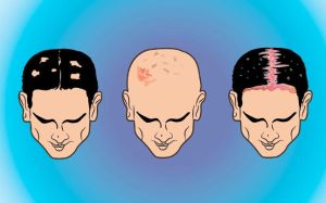 怎樣治療男性頭皮乾燥
