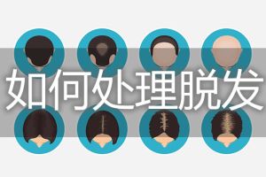 如何處理脱髮