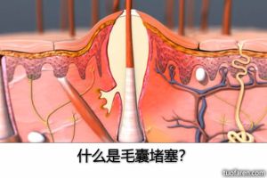 什麼是毛囊堵塞？