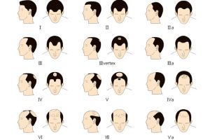 大多數男人仍然不瞭解脱髮是可逆的！