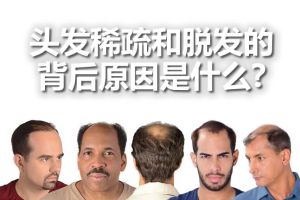 頭髮稀疏和脱髮的背後原因是什麼?