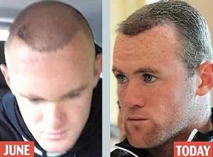 毛髮移植的過程和方法