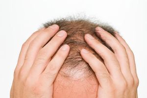 天然脱髮產品可防止頭髮脱落