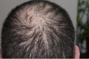 用於脱髮治療的精油