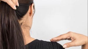 去除頭皮屑的自然方法