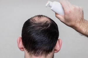 自然方式預防和治療禿頭