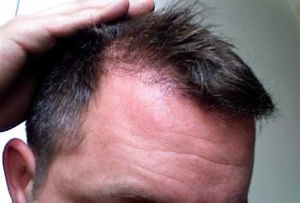 脱髮是由3個原因引起