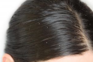 怎樣才能治療頭皮發癢和頭皮屑?