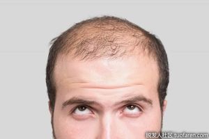 睾丸激素如何影響脱髮