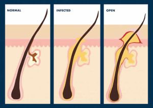 如何治療發炎的毛囊