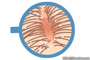 頭皮頭屑多怎麼辦？