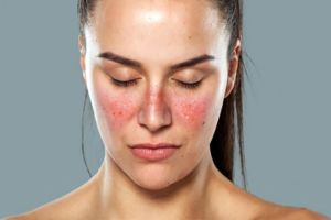 狼瘡和脱髮之間有什麼聯繫?