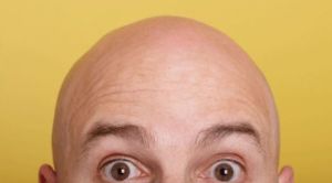 你應該知道的4種禿頂治療方法