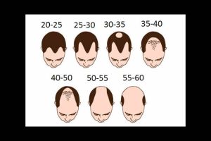 男性脱髮遺傳學：有什麼方法可以預測脱髮嗎？