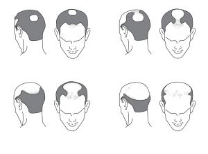 雄激素性脱髮的原因是什麼？
