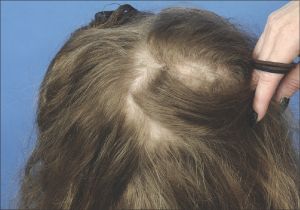 疤痕性脱髮的治療