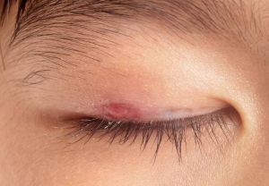 如何治療向內生長的睫毛