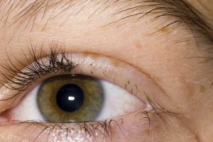 什麼是睫毛斑禿