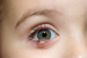 霰粒腫和睫毛脱落