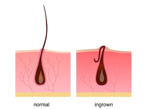 如何防止鬍鬚向內生長