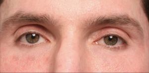 為什麼有些人沒有睫毛？