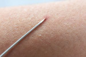 如何去除手臂內生毛髮