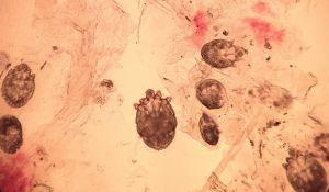 如何去除頭髮上的疥瘡