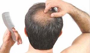 脱髮：睾丸激素是罪魁禍首嗎？
