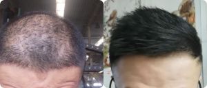 十年脱髮，用米諾地爾和增效，兩個月就能長回來？!