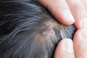 茶樹油的使用方法（用於頭皮痤瘡）