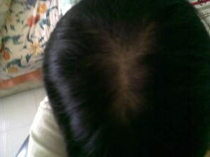 米諾地爾需要多長時間使頭髮完全再生？