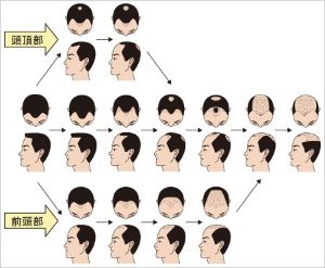 男性雄激素源性脱髮的治療
